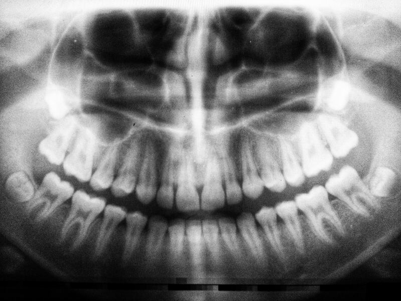 full mouth xrays, showing all the teeth